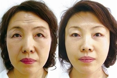 Skin Care / Skin Rejuvenation Machine 10MHZ With Non Invasive