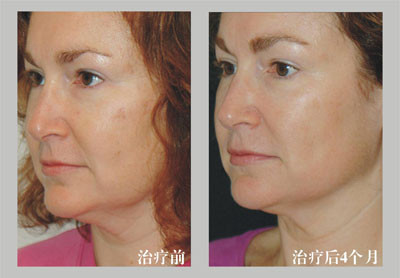 Non Surgical RF Face Lifting Acne Removal Machine For Skin Rejuvenation