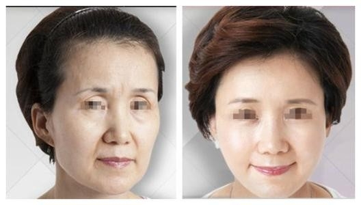 Non Surgical RF Face Lifting Acne Removal Machine For Skin Rejuvenation