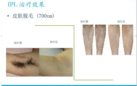 E Light Salon IPL Hair Removal Machines Vertical For Women