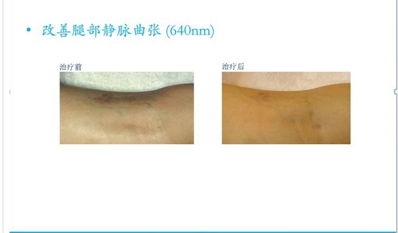 E Light Salon IPL Hair Removal Machines Vertical For Women