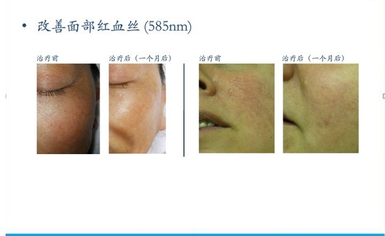 E Light Salon IPL Hair Removal Machines Vertical For Women