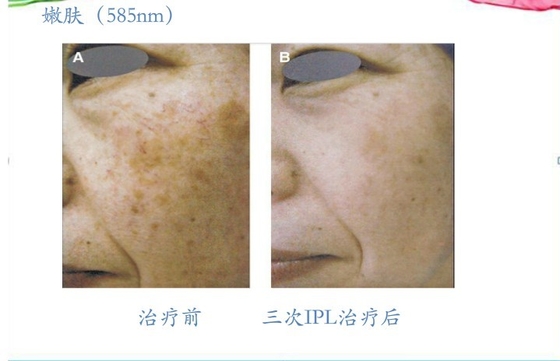 E Light Salon IPL Hair Removal Machines Vertical For Women