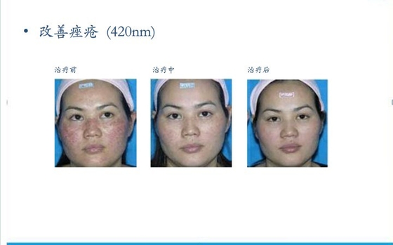 E Light Salon IPL Hair Removal Machines Vertical For Women