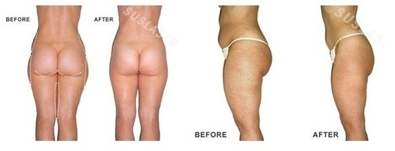 GS8.0 Ultrasonic Liposuction RF Vacuum Cavitation Slimming Machine 40000hz